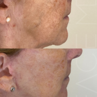 2 Months After 1 treatment of CO2 Laser and a Deep Plane Face & Neck Lift