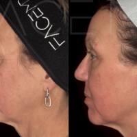 1 week after 1 treatment of CO2 Laser