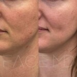 Great results after only 2 BBL sessions for this patient