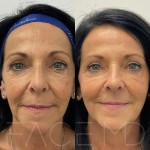 Rejuvinated features after two sculptra treatments to stimulate collagen production