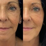 Rejuvinated features after two sculptra treatments to stimulate collagen production