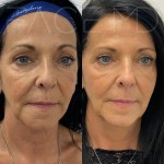 Rejuvinated features after two sculptra treatments to stimulate collagen production