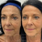 Rejuvinated features after two sculptra treatments to stimulate collagen production